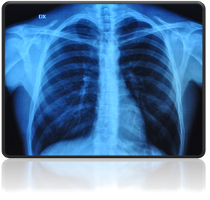 rentgen klatki piersiowej